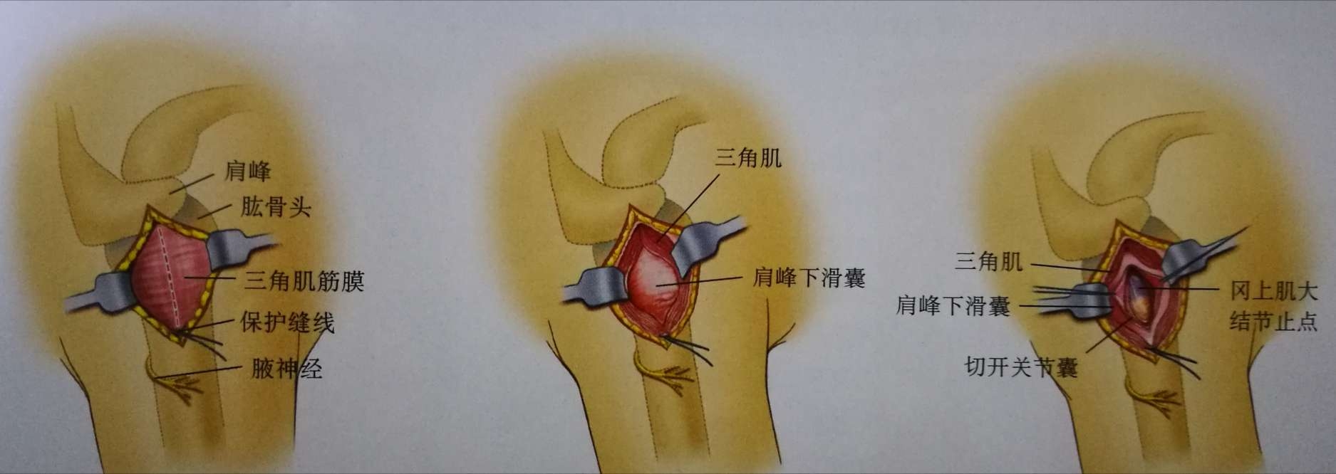 骨折的复位和固定技巧:在冈上肌肌腱止点腱骨交界处缝置缝线,牵拉缝线